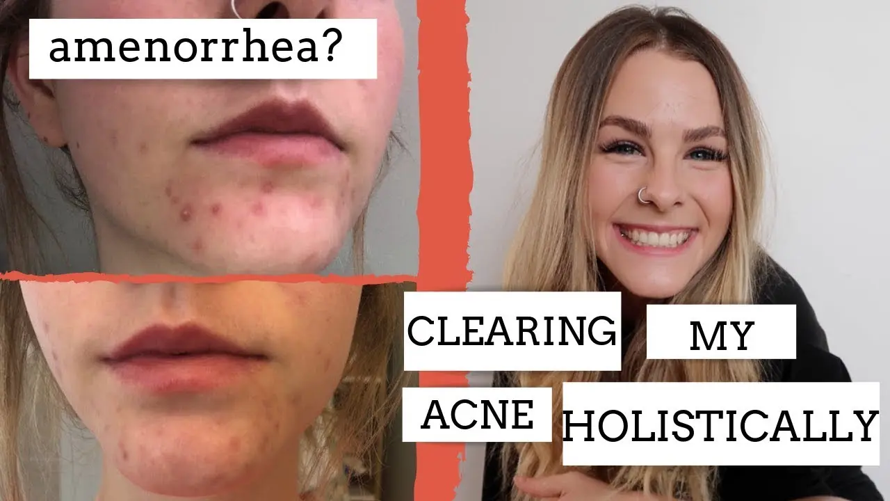 Acne treatment and amenorrhea