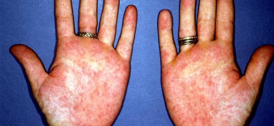 Acquired erythema of hands and feet