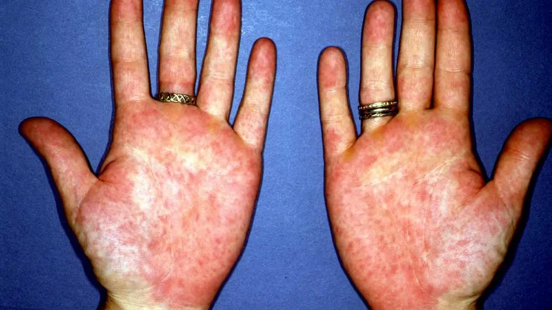 Acquired erythema of hands and feet