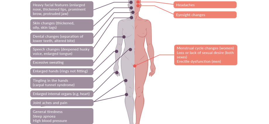 Acromegaly &#8211; watch out for symptoms, save a life!