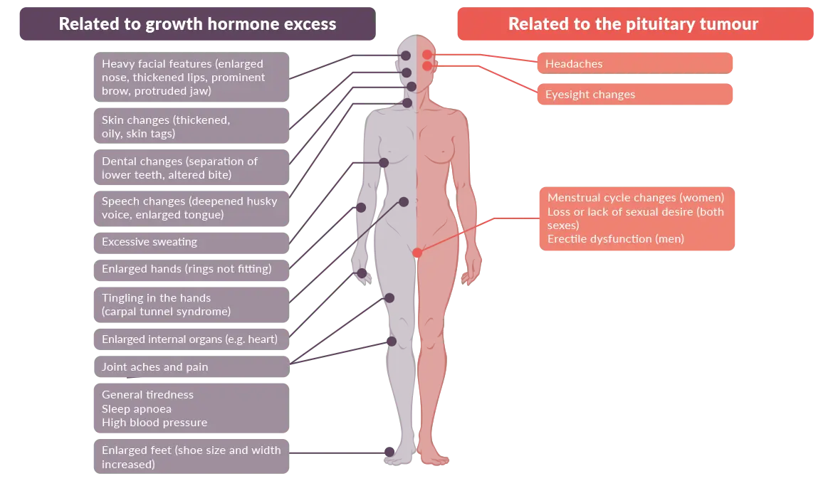 Acromegaly &#8211; watch out for symptoms, save a life!