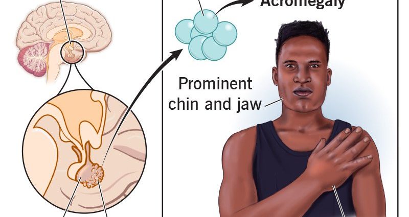 Acromegaly &#8211; what does excess growth hormone lead to?