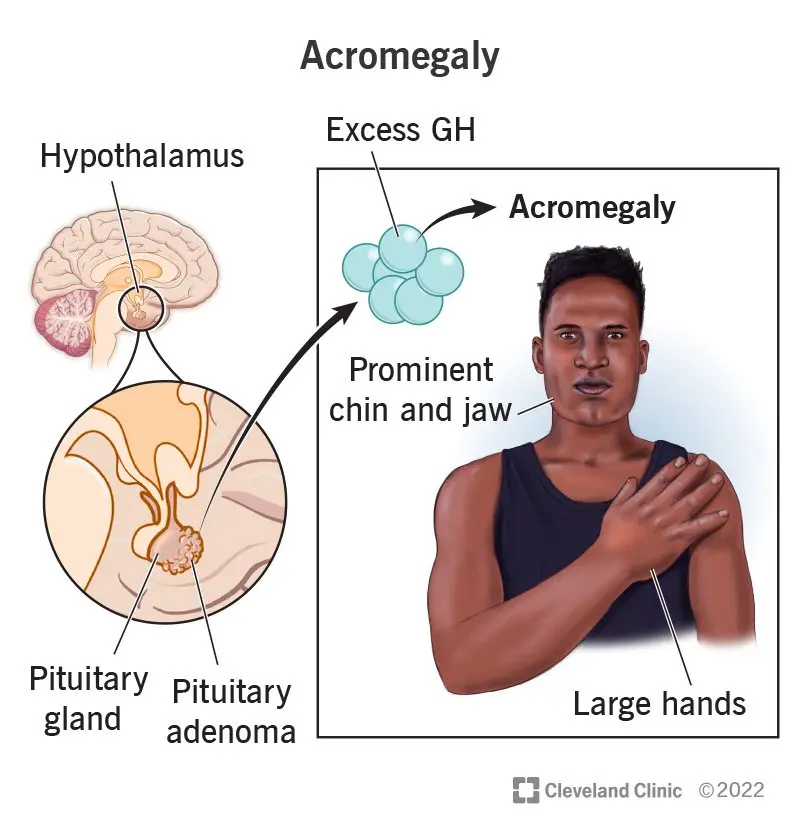 Acromegaly &#8211; what does excess growth hormone lead to?