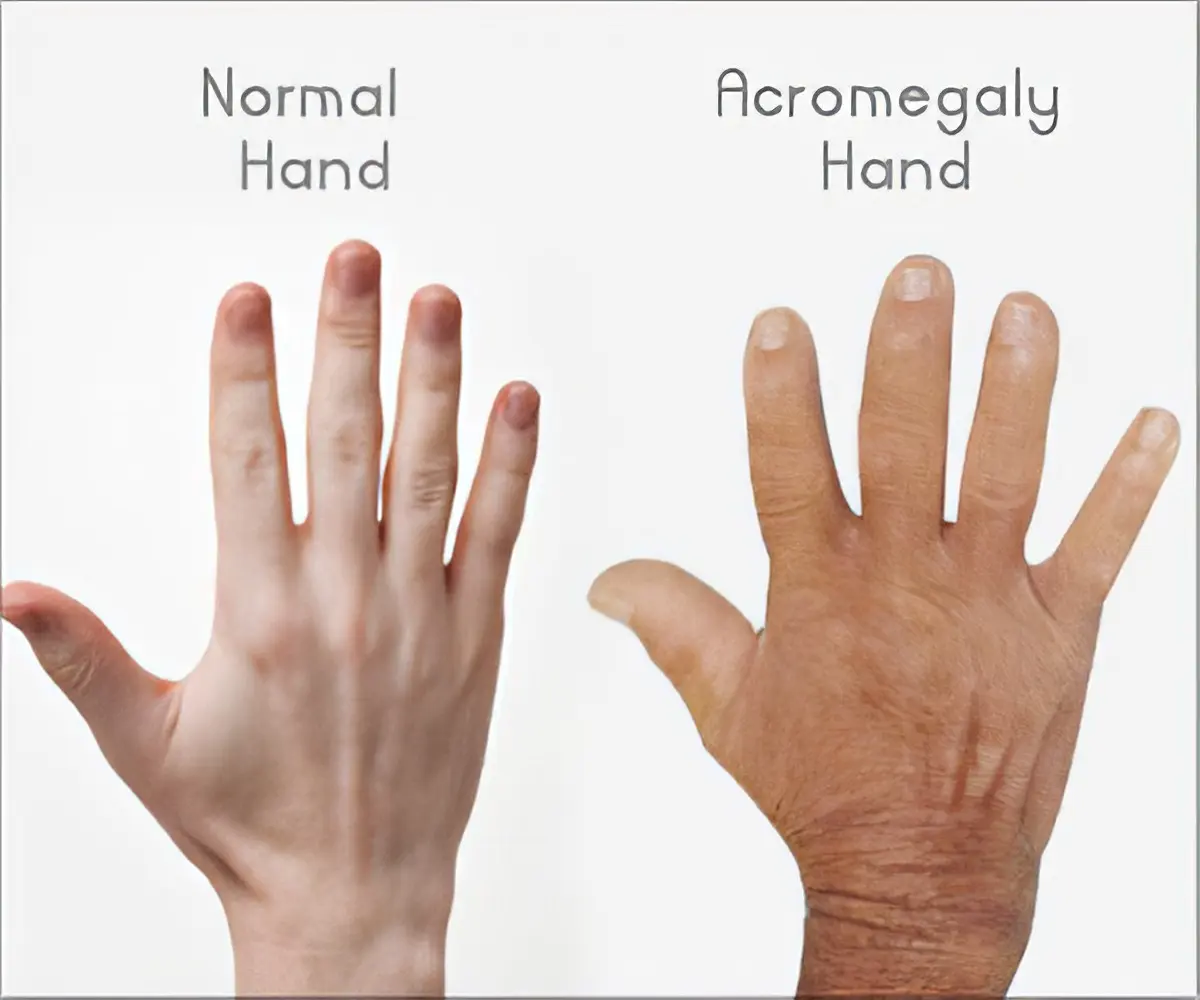 Acromegaly &#8211; what is the disease?