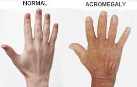 Acromegaly