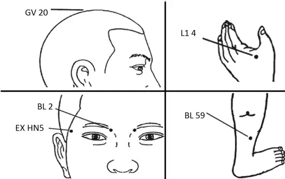 Acupuncture helpful in the treatment of &#8220;lazy eye&#8221;