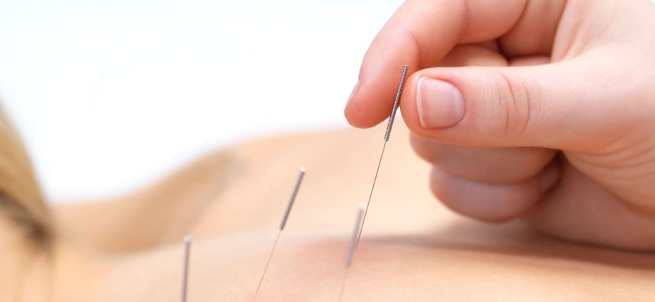 Acupuncture helps combat chronic stress