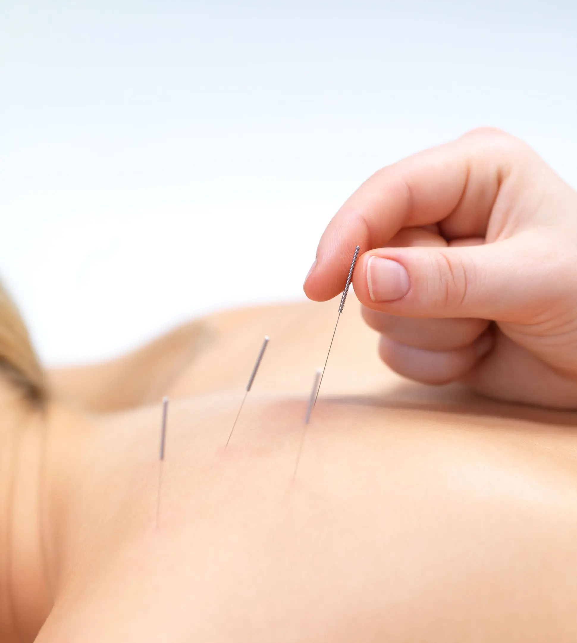 Acupuncture helps combat chronic stress