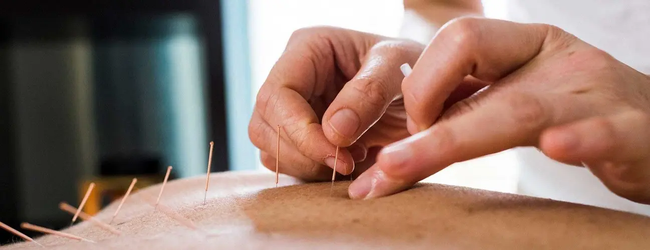 Acupuncture &#8211; what is this treatment method? When is it worth using acupuncture?