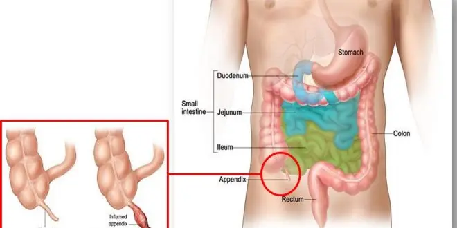 Acute appendicitis