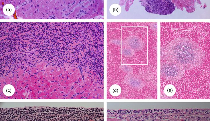 Acute inflammatory infiltrate &#8211; treatment