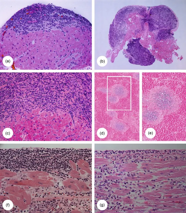 Acute inflammatory infiltrate &#8211; treatment