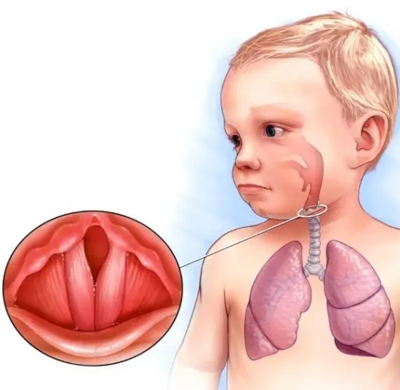 Acute laryngitis in young children &#8211; symptoms and treatment