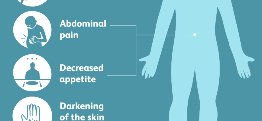 Addison&#8217;s disease (primary adrenal insufficiency) &#8211; symptoms, causes and treatment of the disease