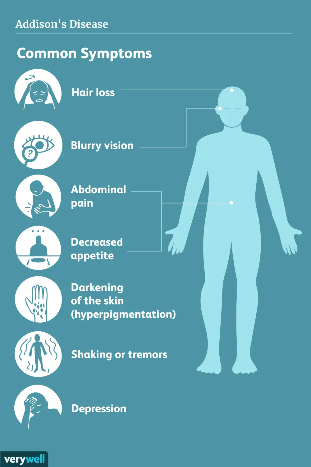 Addison&#8217;s disease (primary adrenal insufficiency) &#8211; symptoms, causes and treatment of the disease