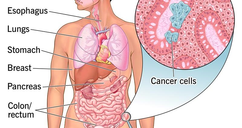 Adenocarcinoma &#8211; types, causes, symptoms, diagnosis and treatment