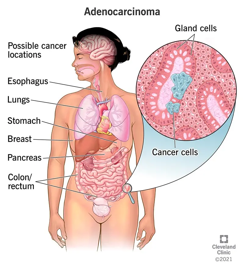 Adenocarcinoma &#8211; types, causes, symptoms, diagnosis and treatment