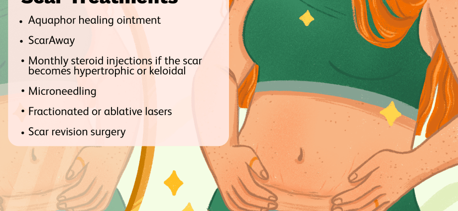 After cesarean surgery, and acne. How do scars form on our bodies?