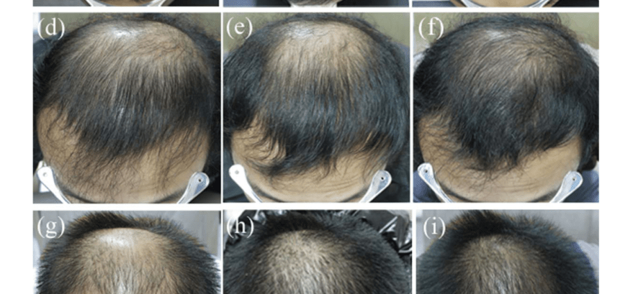 AGA &#8211; the most common male problem. How to stop hair loss?