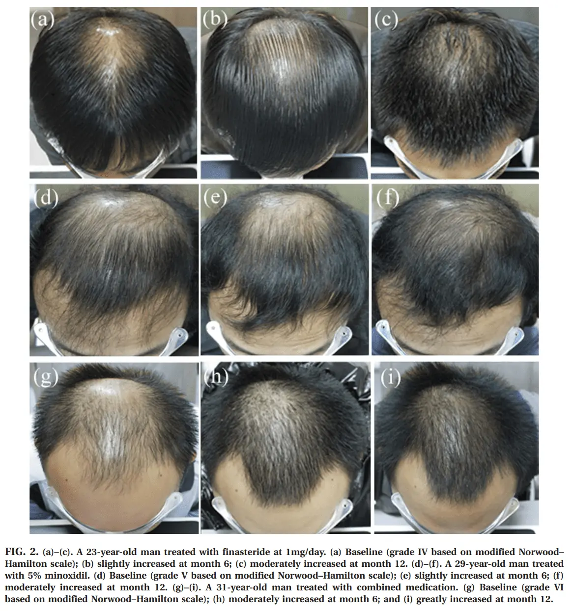 AGA &#8211; the most common male problem. How to stop hair loss?