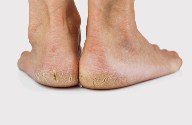 Ailments that can disfigure your feet in the summer