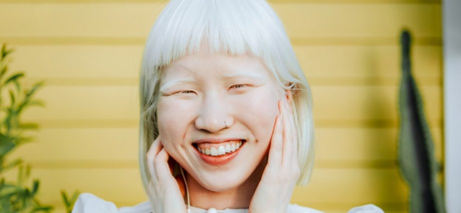 Albinism &#8211; description, symptoms, treatment. Who is an albino really?