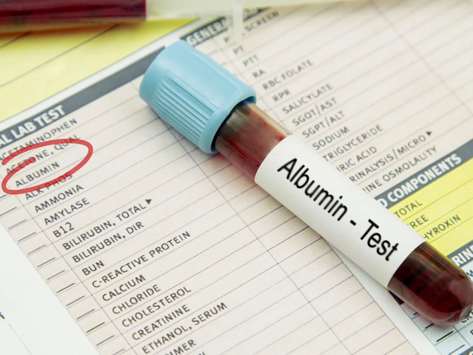 Albumin &#8211; when should the test be performed? Albumin standards