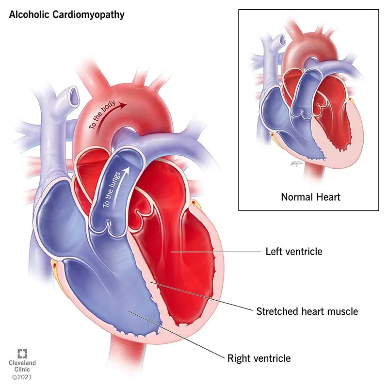 Alcohol affects the left ventricle differently than the right ventricle