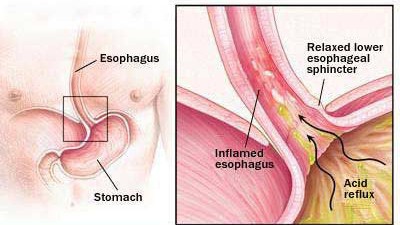 Alcohol and acid reflux disease