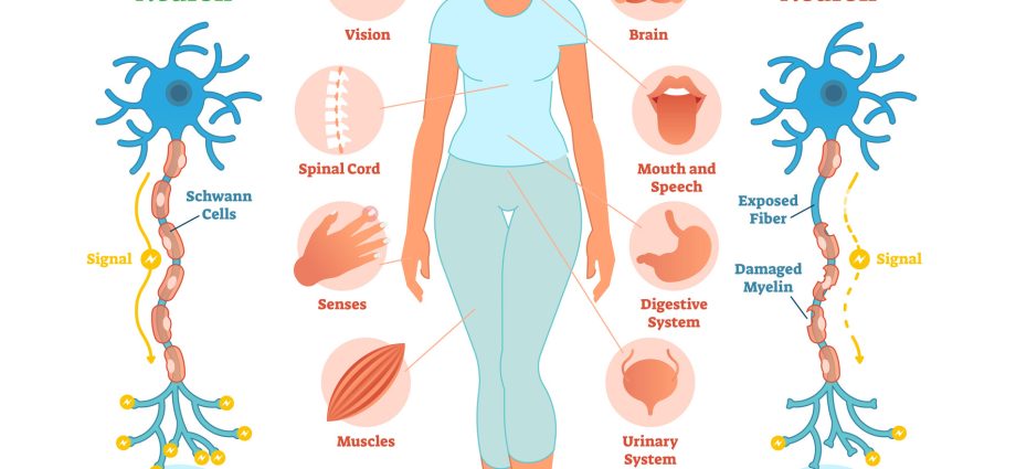 All about multiple sclerosis