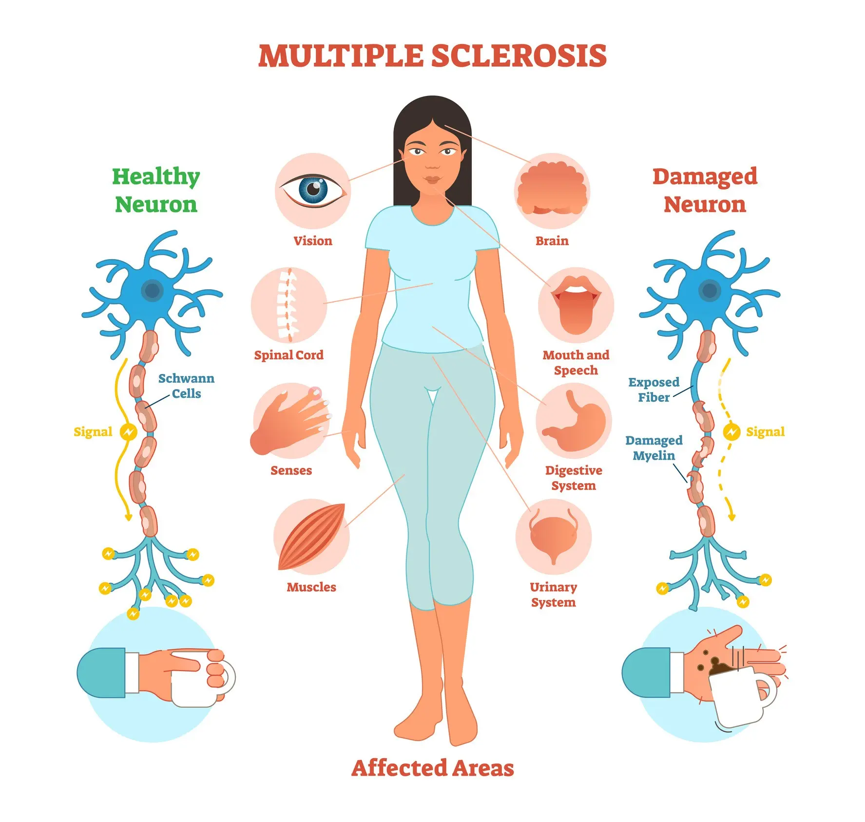 All about multiple sclerosis