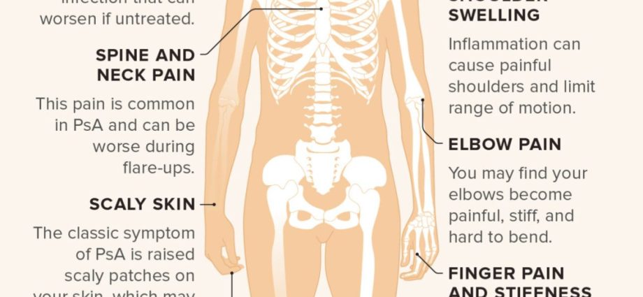 All about psoriatic arthritis