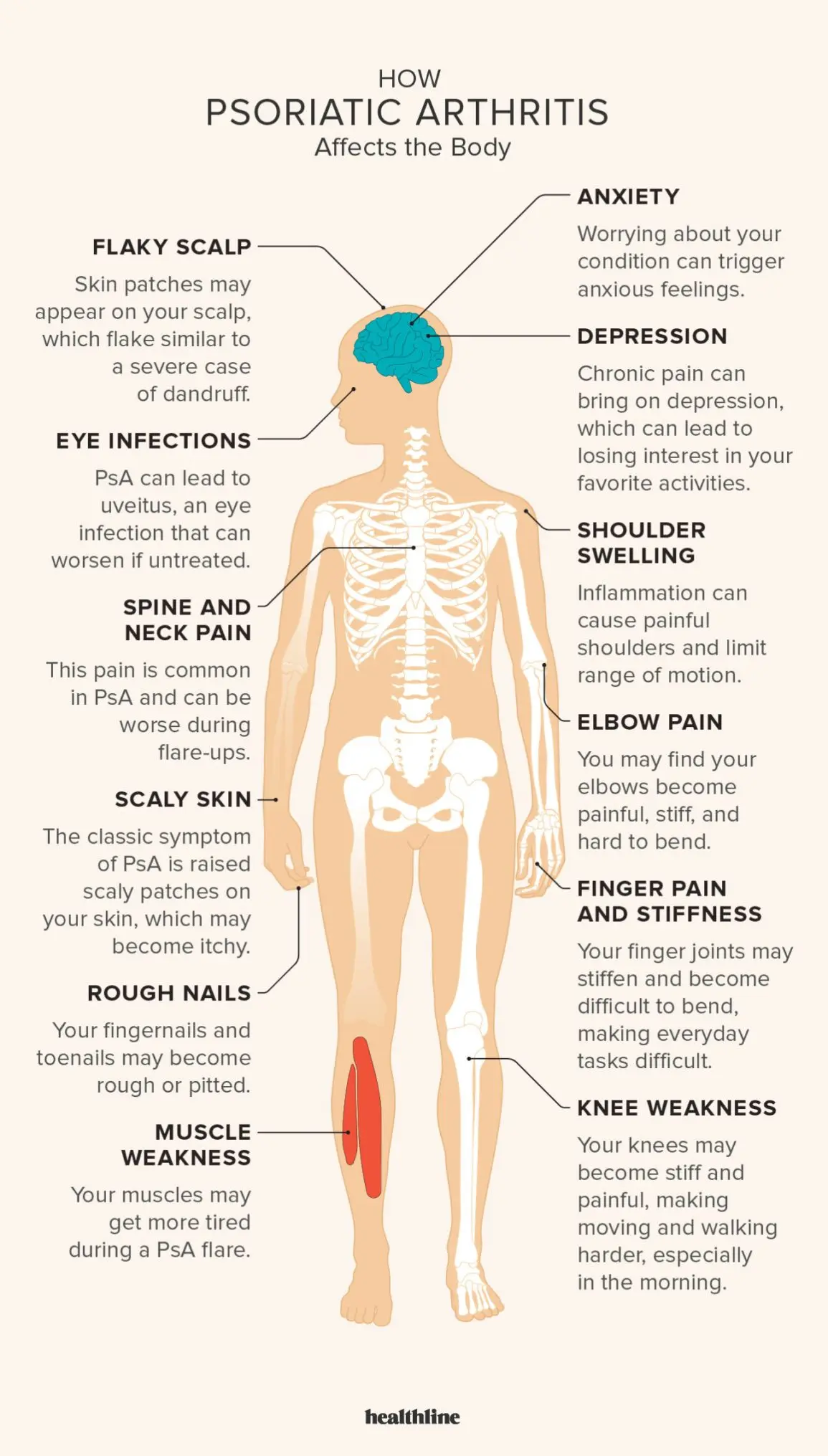 All about psoriatic arthritis