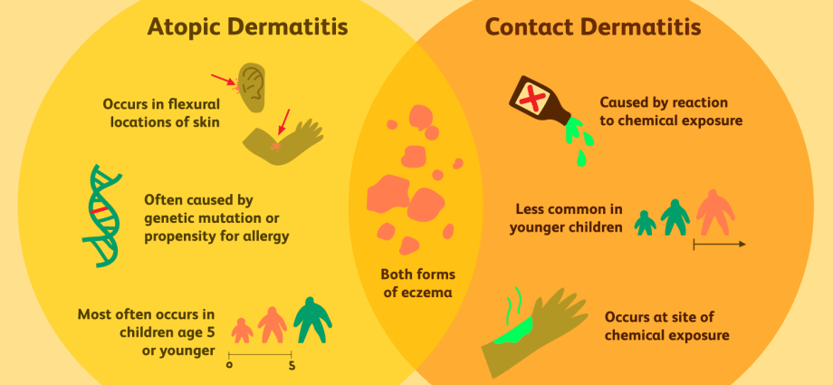 Allergic and non-allergic contact eczema &#8211; treatment and symptoms