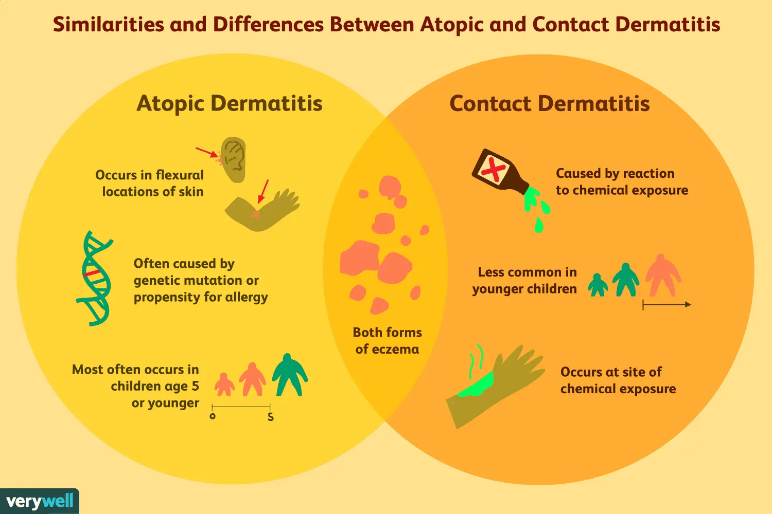 Allergic and non-allergic contact eczema &#8211; treatment and symptoms