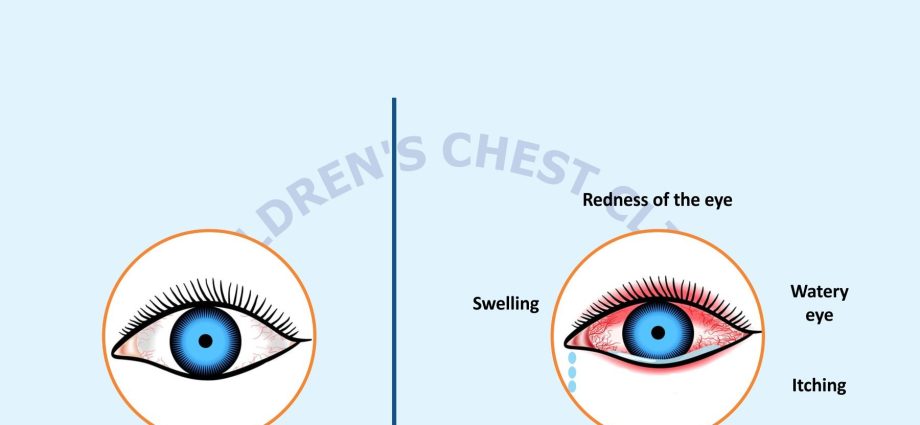 Allergic conjunctivitis