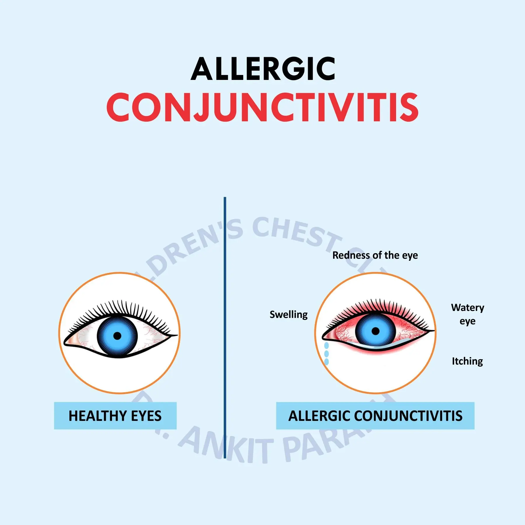 Allergic conjunctivitis