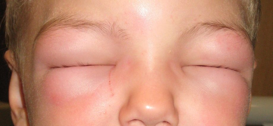 Alergijski edem – uzroci i liječenje. Vrste alergijskog edema