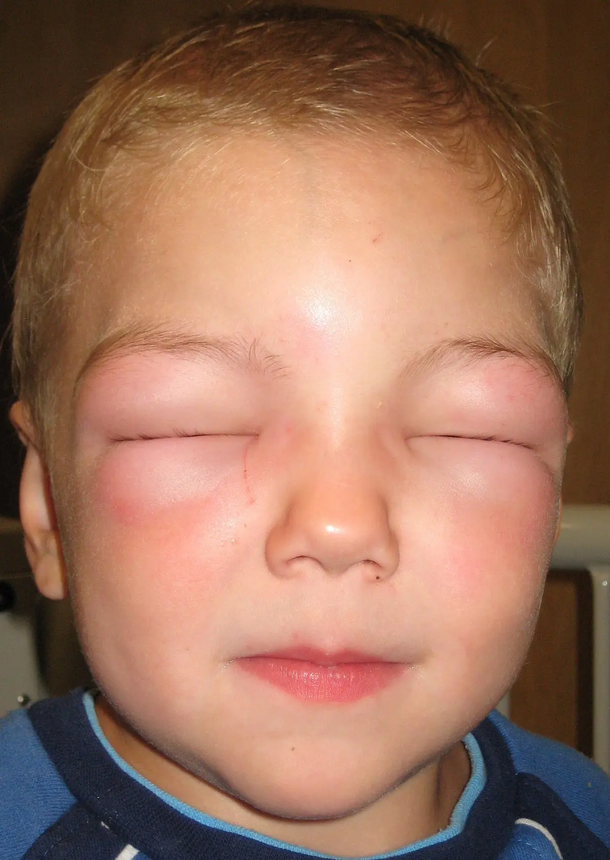 Allergic edema &#8211; causes and treatment. Types of allergic edema