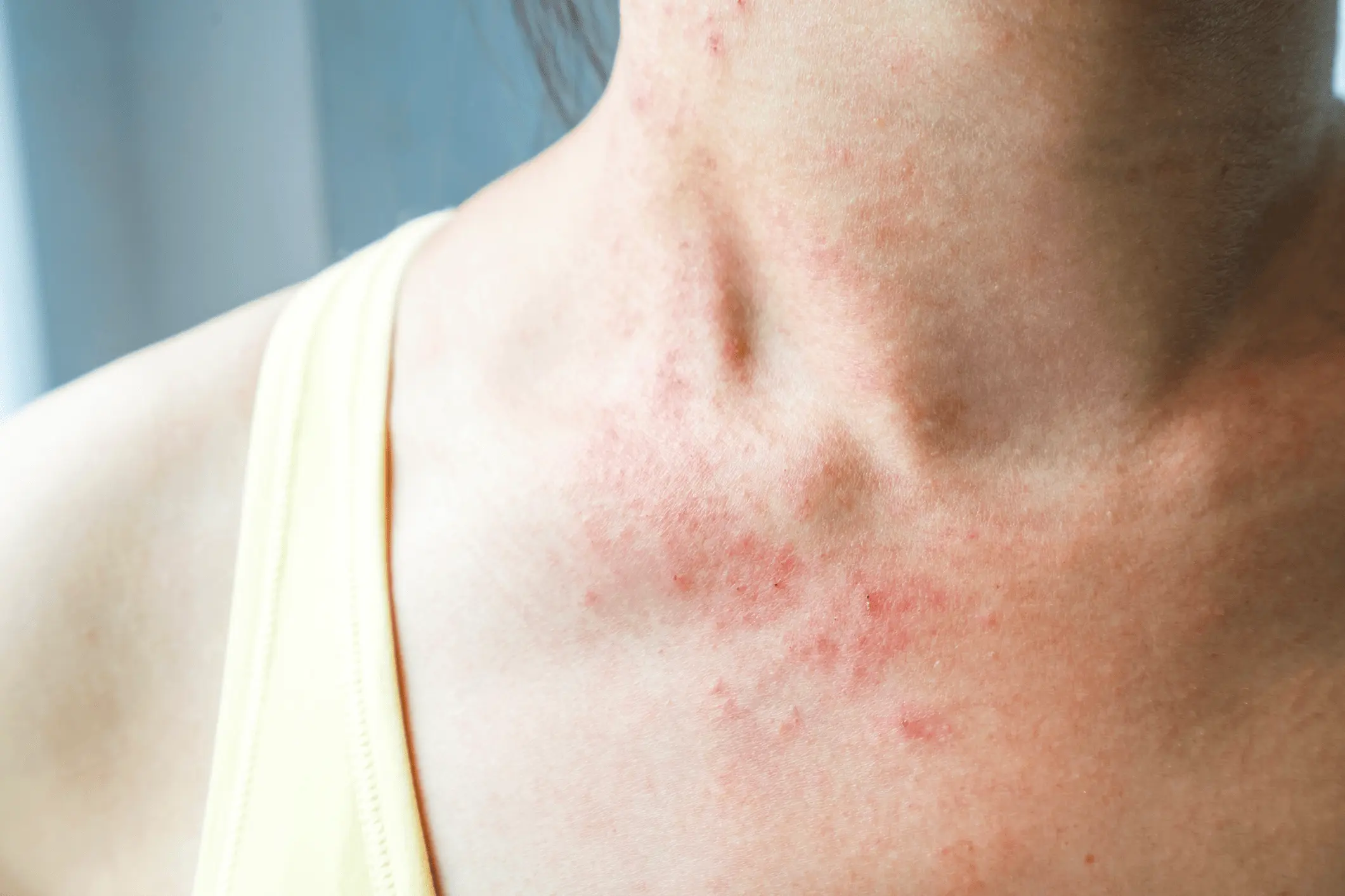 Allergic skin diseases &#8211; how to recognize, types, symptoms