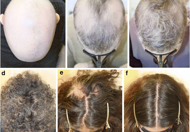 Alopecia after infectious diseases, poisoning, drugs