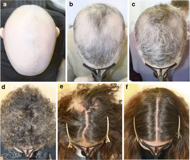 Alopecia after infectious diseases, poisoning, drugs