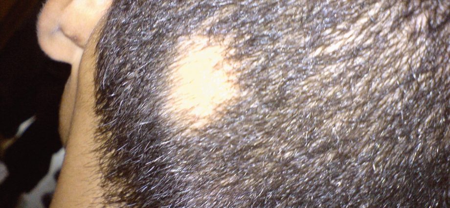 Alopecia areata