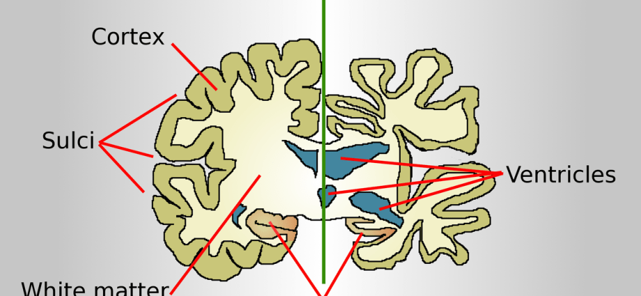 Alzheimer&#8217;s Disease &#8211; Slow degeneration of the mind