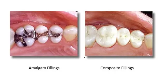 Amalgam fillings &#8211; are they harmful? When should they be removed?