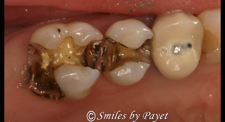 Amalgam fillings &#8211; what is hidden in our teeth?