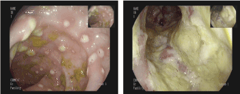 Amoeboma (amoebic tumor of the colon) &#8211; what is it?