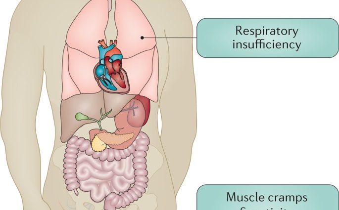 Amyotrophic lateral sclerosis