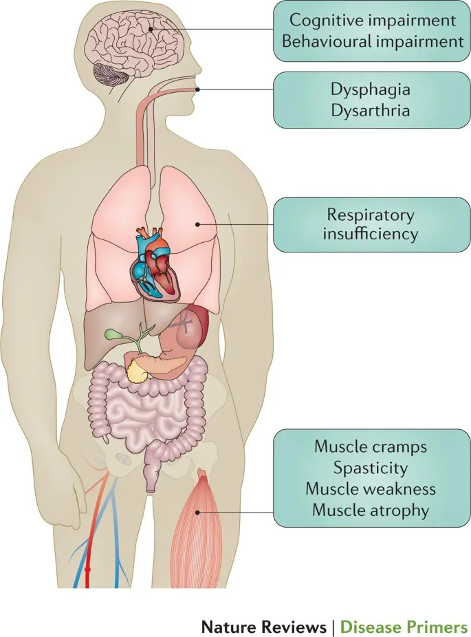 Amyotrophic lateral sclerosis