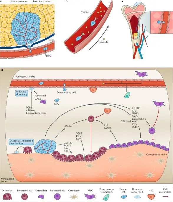 An enzyme that promotes prostate cancer metastasis has been identified